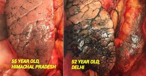 शरीर के हर हिस्से को रोगी बनाता है वायु प्रदूषण